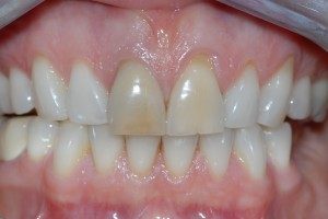Cosmetic Dentistry Dental Implant Centers