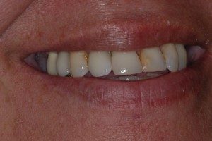 Teeth Examples Dental Implants Center