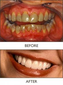 Examples of dental implants on teeth