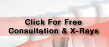 free xrays Dental Implants Center