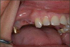 mult teeth Examples of dental implants on teeth