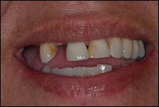 Examples of dental implants on teeth