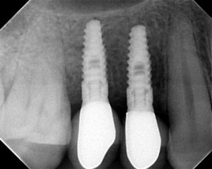 mult teeth Examples of dental implants on teeth 5 xray