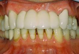 multiple teeth implants