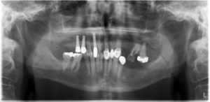 multiple teeth implants
