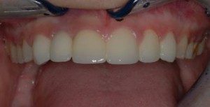 one implant Cosmetic Dentistry Dental Implant Centers