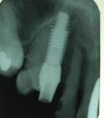 one tooth Cosmetic Dentistry Dental Implant Centers