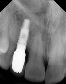 one tooth implant