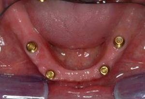 Replacing All Teeth Dental Implants