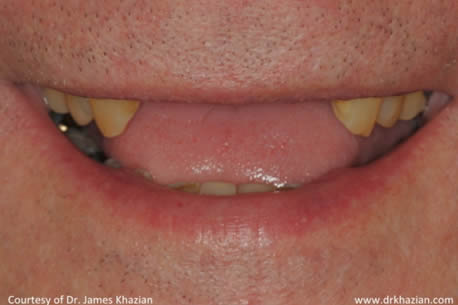 Upper Front Teeth Implant Replacement Case Study.