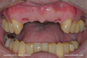 Upper Front Teeth Implant Replacement Case Study.