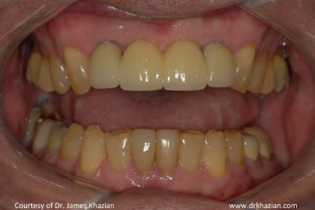 Upper Front Teeth Replacement5