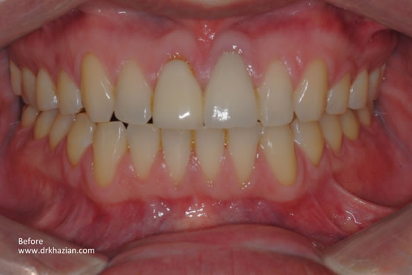 Upper Missing Front Tooth Case Study | San Diego Dental Implant Centers