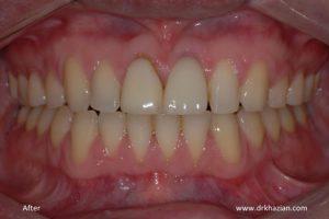 Tooth Dental Implants