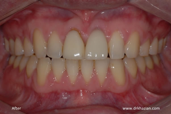 Upper front missing tooth implants