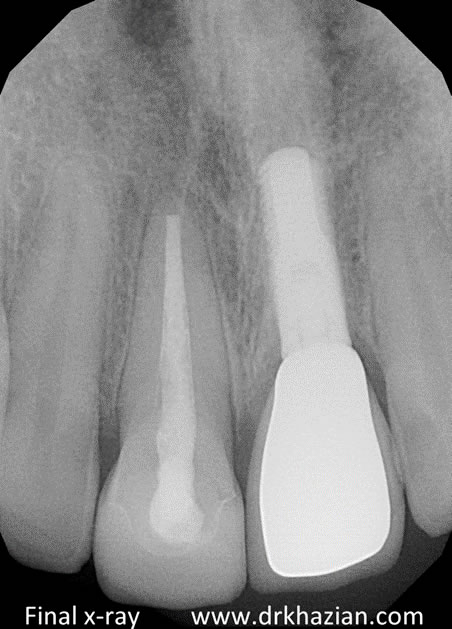 Dental Implant Surgery