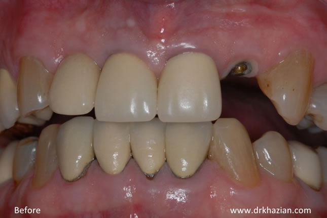 single-tooth-implant