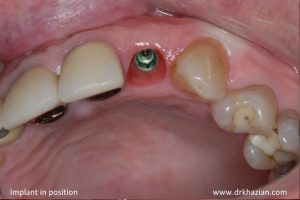 single tooth implant2