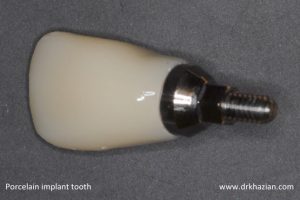 single tooth implant3