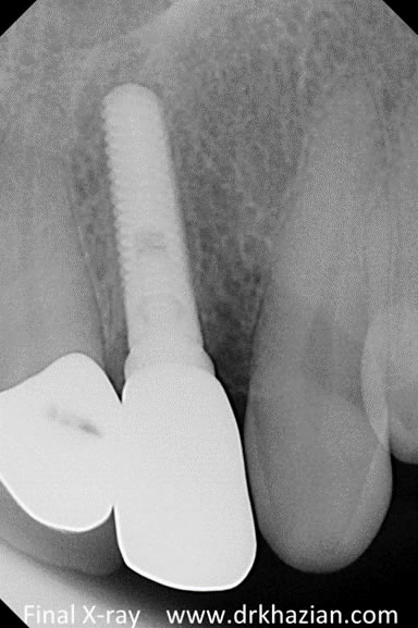 single-tooth-implant 5
