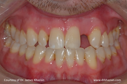 teeth implant