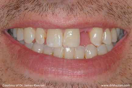 teeth implant2
