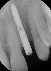 Tooth Dental Implants