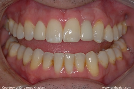 teeth implant5