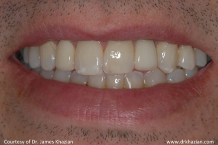 teeth implant6