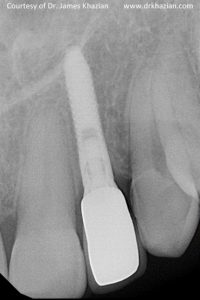 One Tooth Implant x-ray