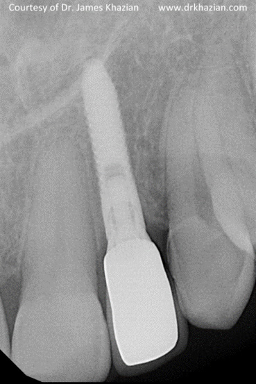teeth implant7