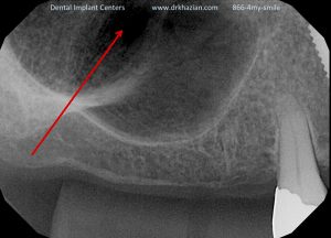 Missing back teeth dental implants. Tooth Implant Study