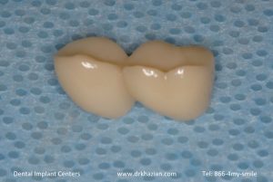 Missing back teeth dental implants. Tooth Implant Study