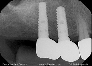 Missing back teeth dental implants