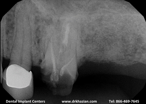 replace molar teeth1