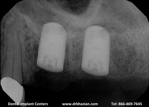 replace molar teeth3