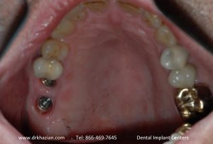 Replace Molar Back Tooth Implants Case.
