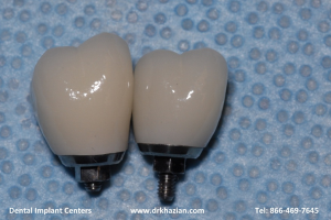 Replaced Molar Back Tooth Implants