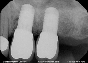 Replace Molar Back Teeth Implants Case Study