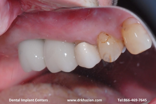 replace molar teeth7