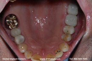 Replace Molar Back Tooth Implants Case