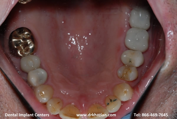 replace molar teeth8
