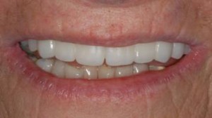 Full Teeth Reconstruction-All on 4 Specialists