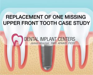 replace missing tooth implants