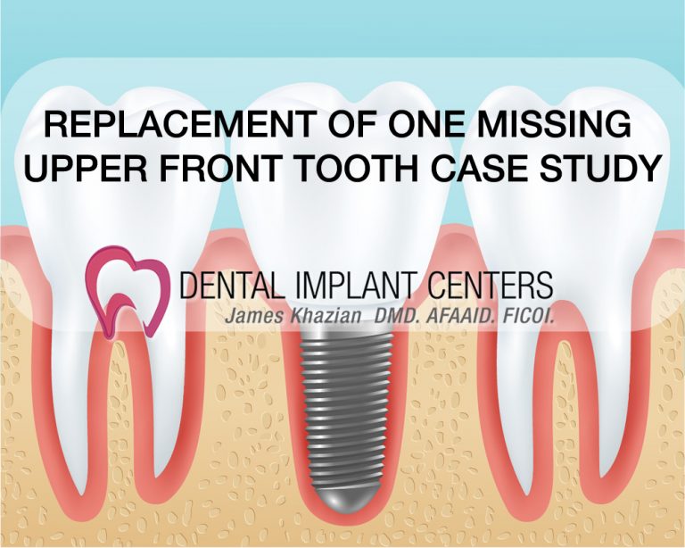 replace missing tooth implants San Diego Dental Implant Centers