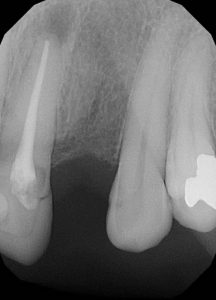 replace missing tooth1