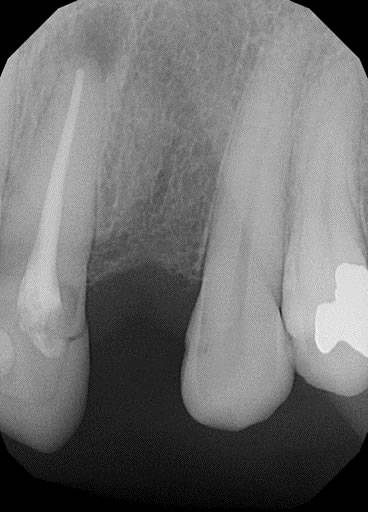 replace missing tooth1