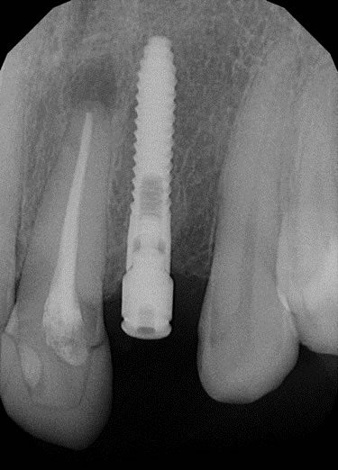 replace missing tooth2