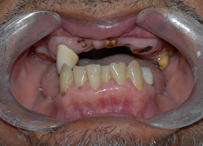 dental implant case study1