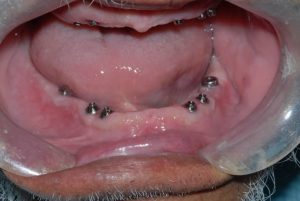 dental implant case study3